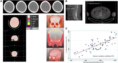 Low skull bone density is associated with poor motor prognosis in women with Parkinson’s disease